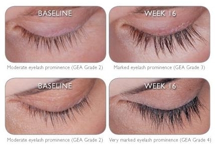 latisse before after
